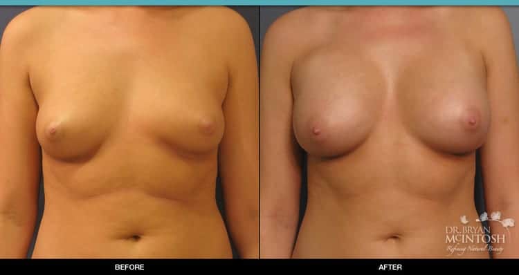 breast-augmentation-1-1