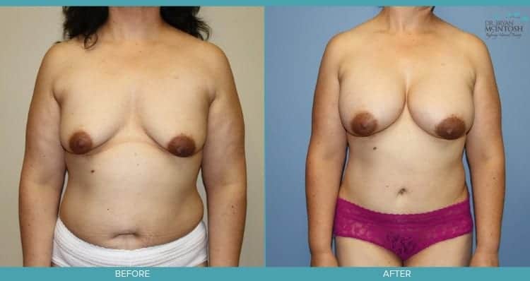 Breast Augmentation & Abdominoplasty