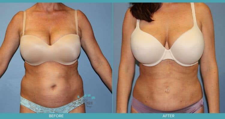 Liposuction to the abdomen, waist and back lift
