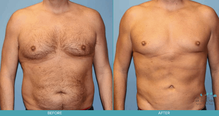 Male Breast Reduction & Liposuction